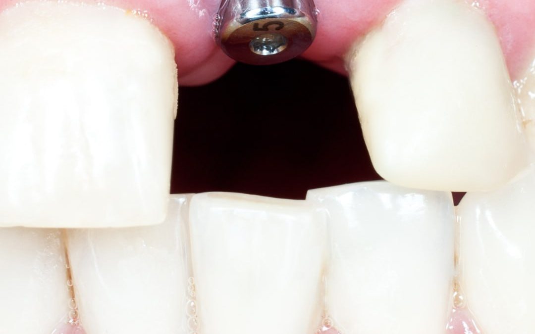 Coronas y Puentes Fijos: Restauración y Funcionalidad