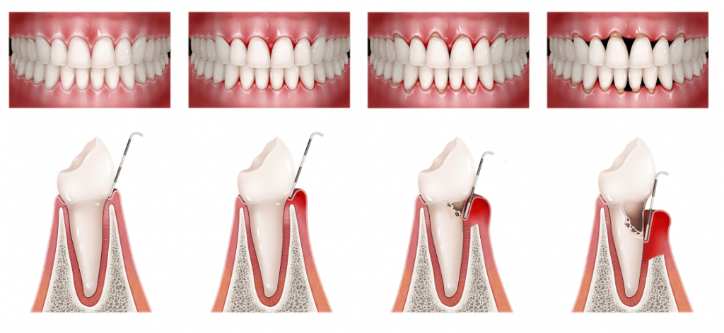 terapia periodontal en duluth