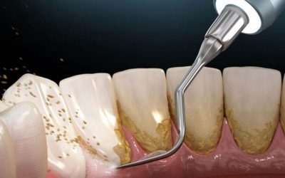 Limpieza Dental: Procedimiento odontológico