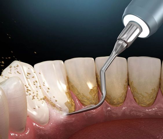 Limpieza Dental: Procedimiento odontológico