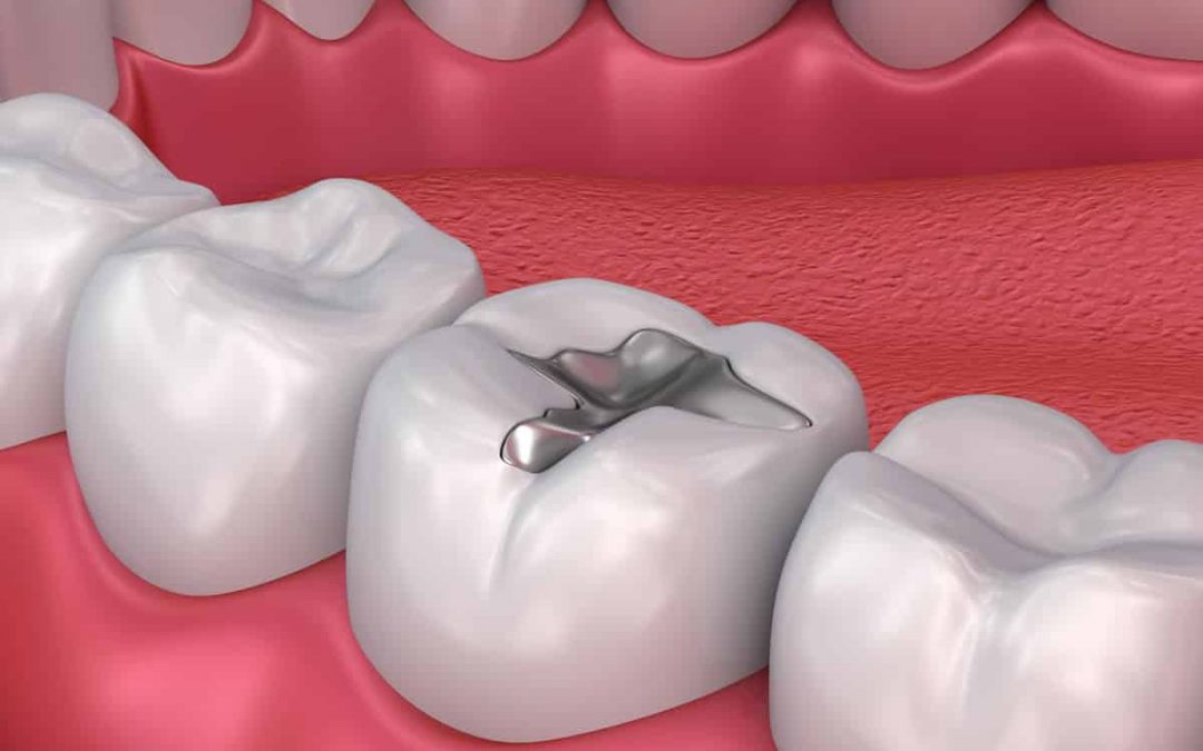 Todo lo que debes saber sobre los rellenos dentales